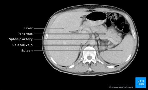 Splenic Artery Rupture Symptoms Diagnosis Treatment Kenhub