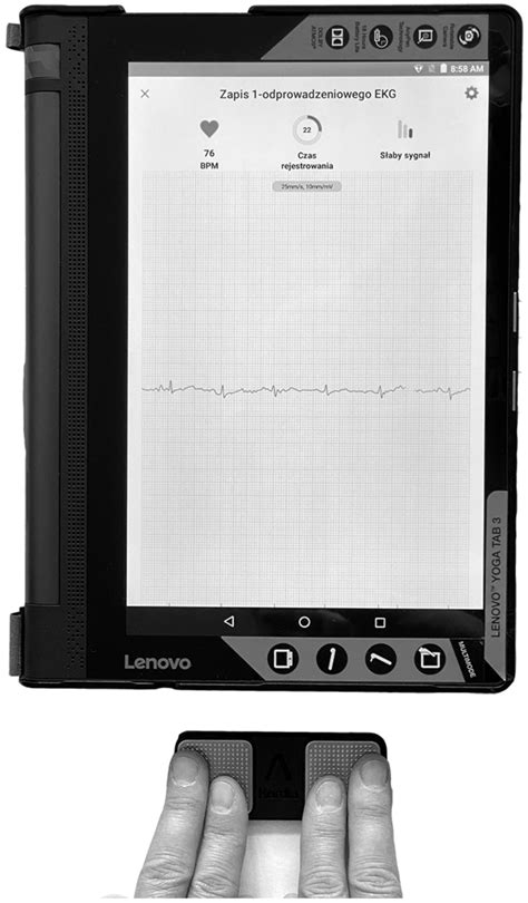 Jcm Free Full Text Mobile Single Lead Electrocardiogram Technology For Atrial Fibrillation