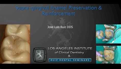 Supra Gingival Enamel Preservation And Reinforcement Ruiz Dental Seminars Video Library