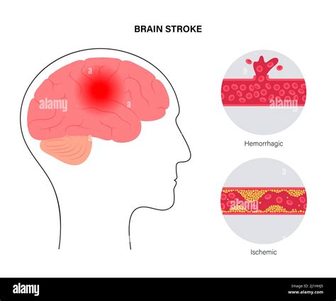 Ischaemic And Haemorrhagic Strokes Illustration Stock Photo Alamy