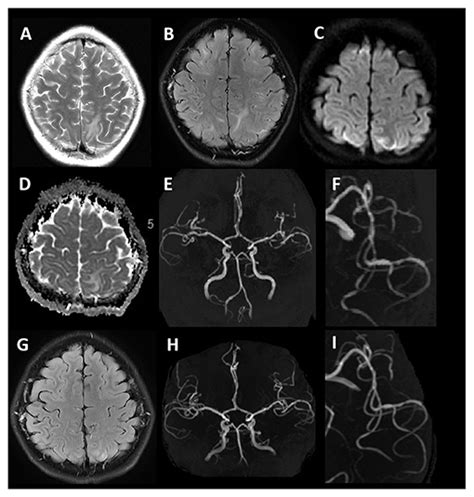 Frontiers Cerebrovascular Disease In The Setting Of Posterior Reversible Encephalopathy Syndrome