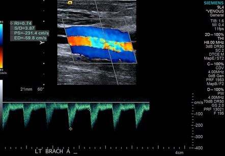 Dialysis Graft Ultrasound