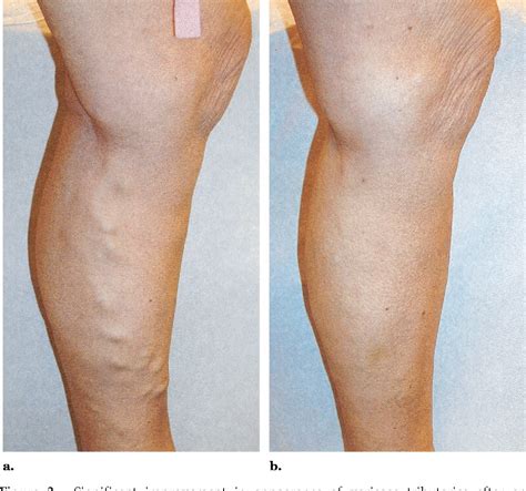 Great Saphenous Vein Structure Semantic Scholar