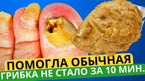 От ГРИБКА НОГТЕЙ можно ТОЧНО избавиться за 10 минут простым... Это есть ...