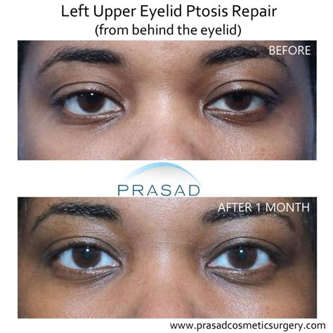 Droopy Eyelid Surgery Eyelid Ptosis Procedure And Recovery