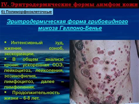 Эритродермии (эксфолиативный дерматит) - презентация онлайн
