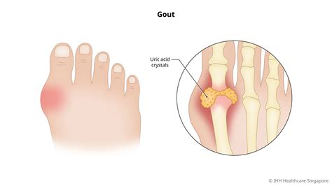 Gout Inflammatory Arthritis Causes And Symptoms Parkway East Hospital