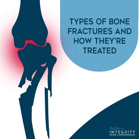 Types Of Bone Fractures And How Theyre Treated Orthopedic Surgeons