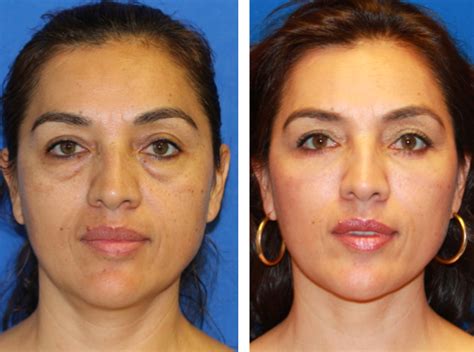 Buccal Fat Removal Melbourne Cheyenne Montero