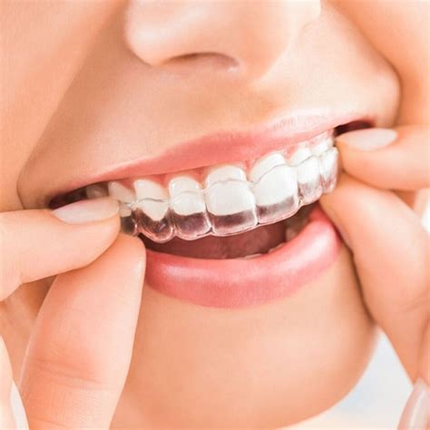 Types Of Braces Central Missouri Orthodontics