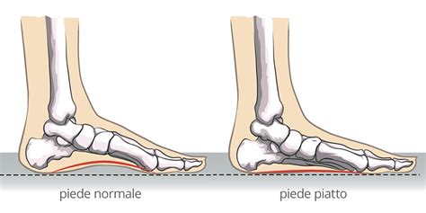 Piede Piatto Dottor Roberto Pelucchi Ortopedico Traumatologo