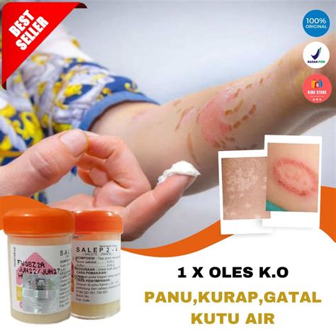 Jual Obat Panu Paling Ampuh Salep Zwafel Gatal Original Sulfur