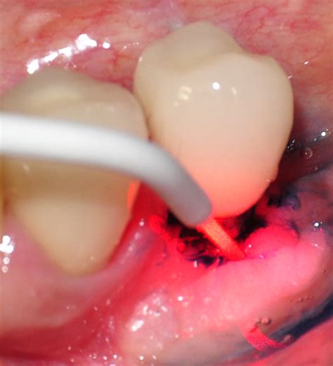 Safe And Effective Photodynamic Therapy Uk