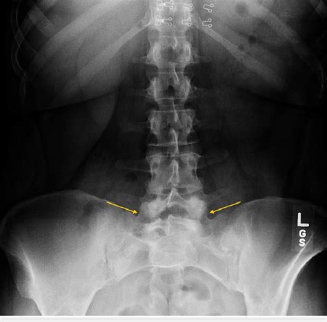 AP X Ray Of The Lumbar Spine And Pelvis AP Radiograph Revealing