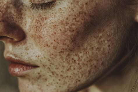 Candidose Chez Les Hommes Symptômes Diagnostic Et Traitement
