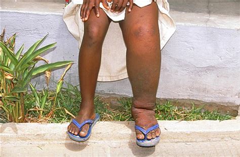 Elephantiasis and its causes | Prostate Cancer Symptoms Tips