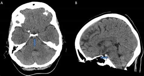 Perimesencephalic Non Aneurysmal Subarachnoid Haemorrhage Bmj Case