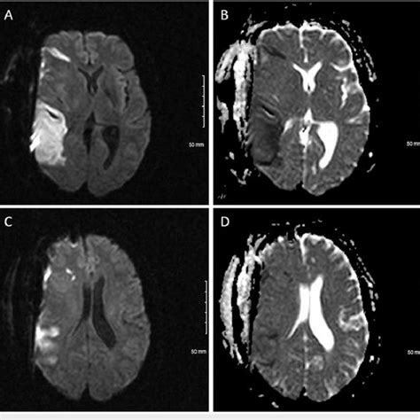 Brain MRI of the patient 36 hours after stroke symptoms Axial ...