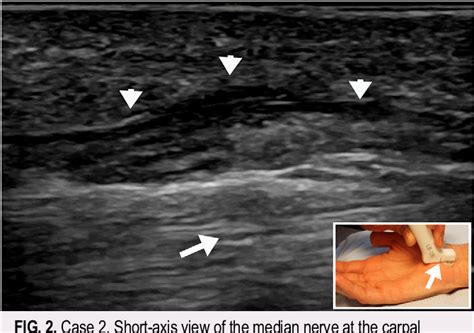 Figure 1 From Iatrogenic Median And Ulnar Nerve Injuries During Carpal