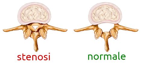 Stenosi Vertebrale Attivazioni Biologiche