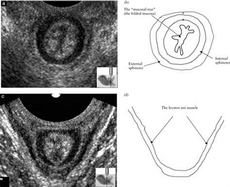 Simple Ultrasound Evaluation Of The Anal Sphincter In Female Patients