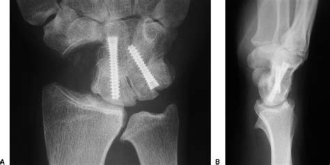 Results Of A Method Of 4 Corner Arthrodesis Using Headless Compression