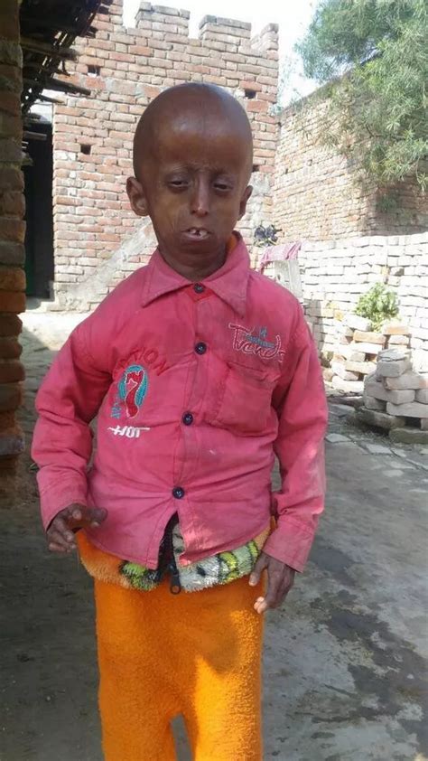 Meet Real Life Benjamin Button As Three Stone Man 21 Is Living In The