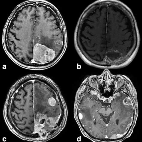 MRI Of Grade I Meningiomas T1 Weighted Gadolinium Enhanced Sequences