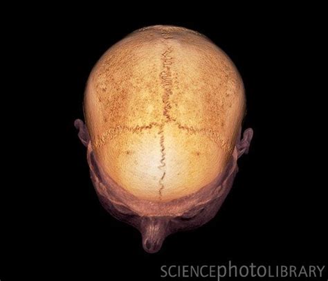 Skull Sutures 3d Ct Scan Sutures Are A Type Of Rigid Fibrous Joint