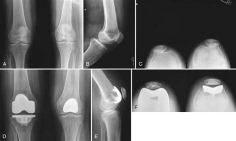 Patellofemoral Arthroplasty | Musculoskeletal Key