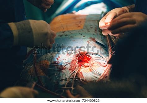 Team Surgeons Operating Wearing Lamp Lighting Stock Photo 734400823