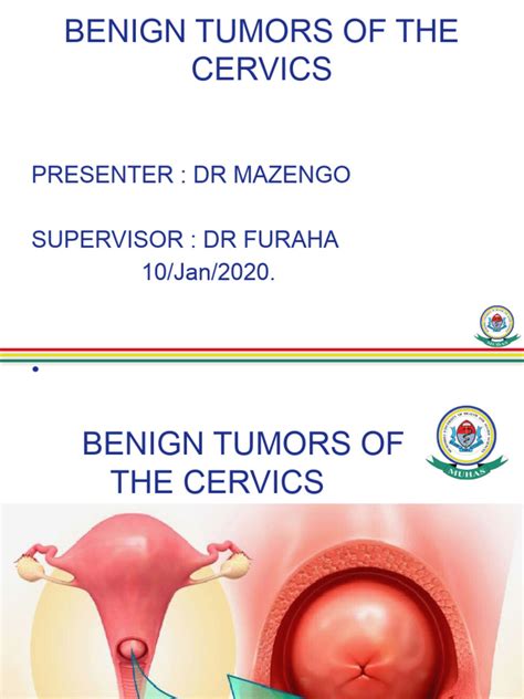 Benign Tumor Of The Cervix Pdf Human Reproduction Medicine