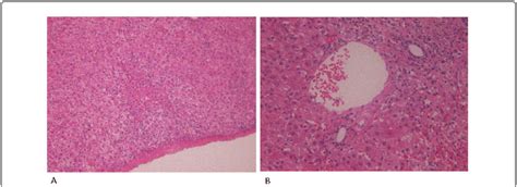 Liver histology: Liver biopsy shows hemorrhagic necrosis (A) and ...