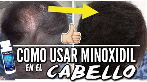 C Mo Aplicar Minoxidil Para Obtener Buenos Resultados Como Usar