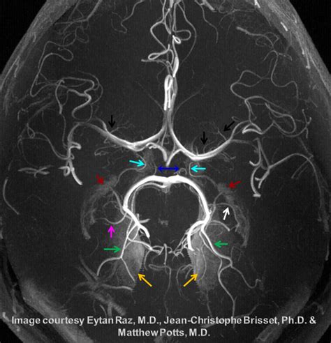 Anterior Choroidal Artery | neuroangio.org