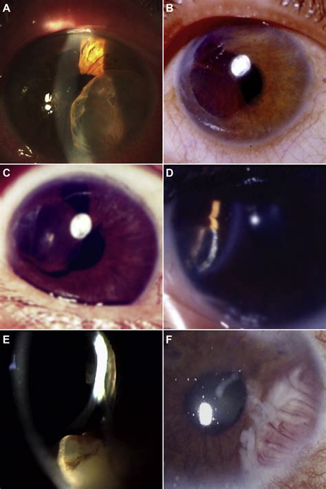 Iris Cysts A Comprehensive Review On Diagnosis And Treatment Survey