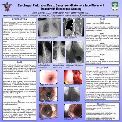 Pdf Esophageal Perforation Due To Sengstaken Blakemore Tube Placement