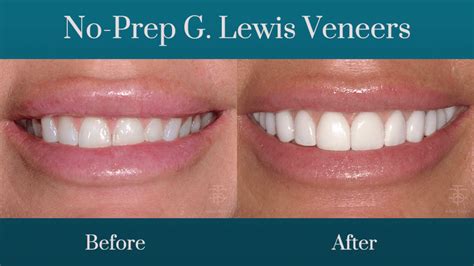 GOODBYE TRADITIONAL VENEERS - HELLO TO NO-PREP VENEERS!