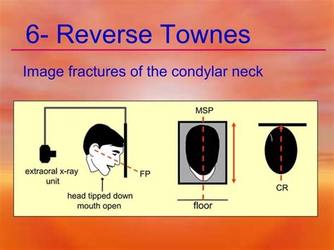 Extra Oral Radiology Techniques Ii Ppt