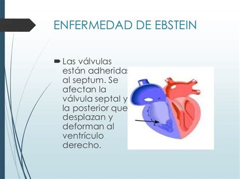 Anomalia De Ebstein Presentacion