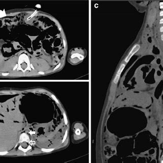 Postmortem Axial Chest Ct Shows Normal Pulmonary Edema In A Month Old