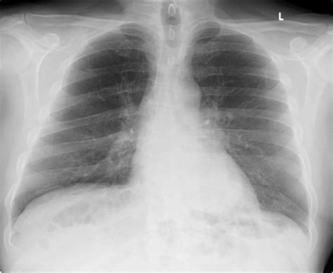 Normal CXR Flashcards Quizlet