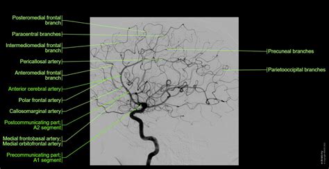 What Is A Cerebral Angiography