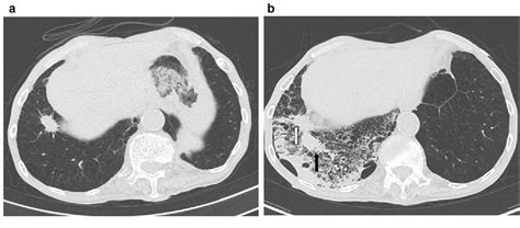 Figure 2 From Comparison Of The Utilities Of Cryobiopsy And Forceps Biopsy For Peripheral Lung