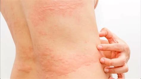 URTICARIA RONCHAS EN EL CUERPO CAUSAS SÍNTOMAS Y TRATAMIENTO