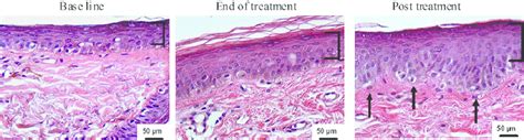 Radiofrequency Treatment Enhances Epidermal Hyperplasia Skin Biopsy