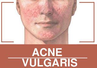 Acne Vulgaris Causes and Prevention - primary health care News