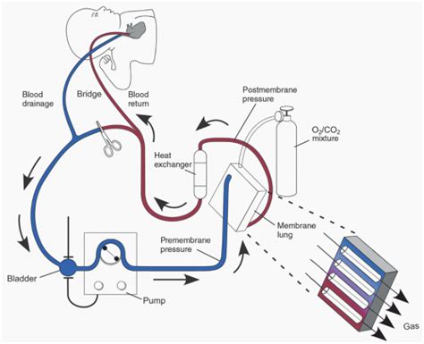 Extracorporeal Membrane Oxygenation In Infants And Children Thoracic Key