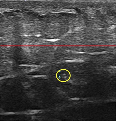 Evaluation Of Lymphatic Vessel Diameters In Healthy People Using