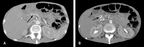 Chronic Pancreatitis Diagnosis And Treatment Aafp